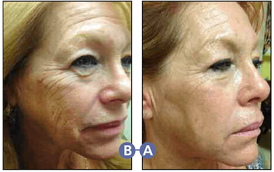 Full Make Over Laser Treatment