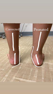 Correction of a pediatric flatfoot