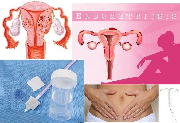 Provides care for women with endometriosis, fibroids, abnormal periods, adenomyosis and routine gyn needs.