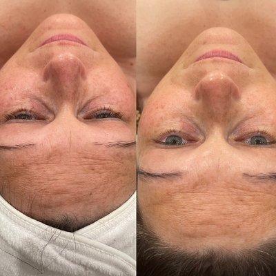 Brightening high frequency facial