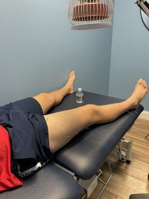 Treatment of quadricep injury strain with acupuncture