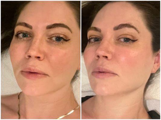 Before and after a jetpeel facial