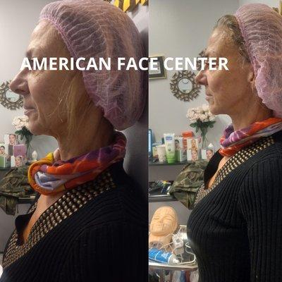 Before and after American Face Client