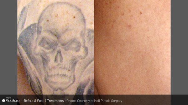 PicoSure Tattoo Removal