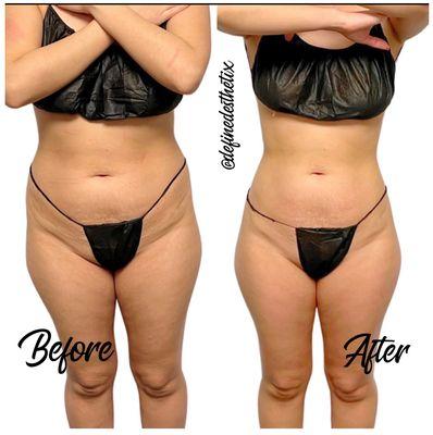 Non-invasive Laser Lipo, radio frequency & cavitation treatment. After one appointment!