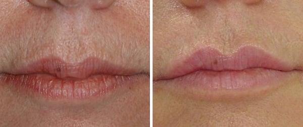 Before and after skin pen microneedling and 1cc syringe of restylane