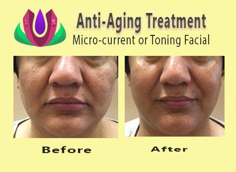 Anti-Aging Treatment - Microcurrent or Toning Facial to lift, tone, firm sagging, drooping complexion.  Female in mid's 40 w/poor elasticity