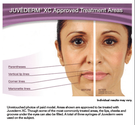 Area's Juvederm can treat