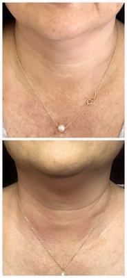 RF Skin tightening treatments on the Neck