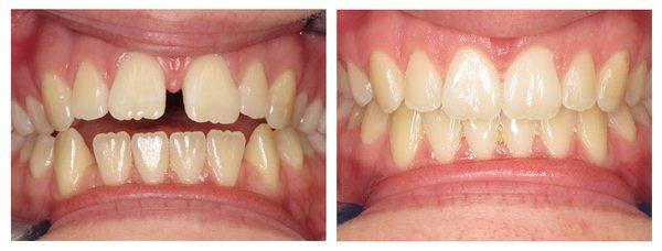 Invisalign results