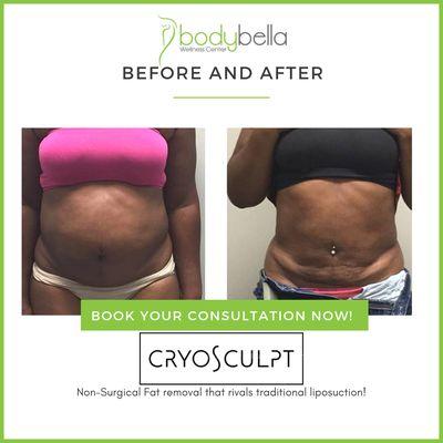 CryoSculpt 45 day before and after of abdomen