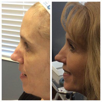 Before & after our min liquid facelift