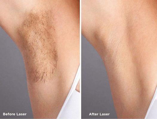 Laser hair removal