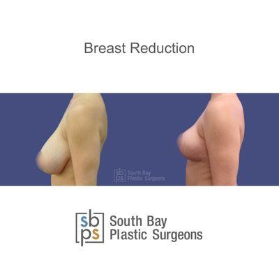 This patient underwent a breast reduction.