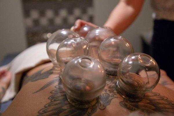 Cupping treatment for tight muscles