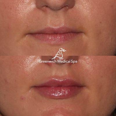 Your solution to fuller lips may include Restylane Kysse, Juvéderm Ultra XC, Volbella, or BOTOX injections.