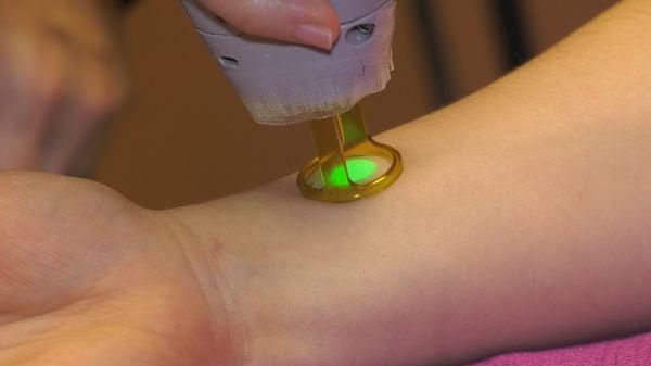 Laser hair removal procedures.