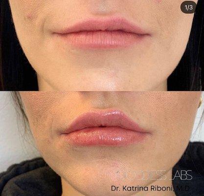 1 CC of Restalyne in Lips