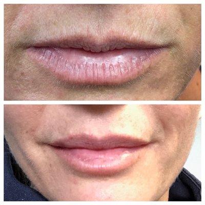 Juvederm filler to perioral lip lines and lips