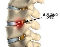 We offer non-Surgical Spinal Decompression Therapy for disc problems in the low back and neck.