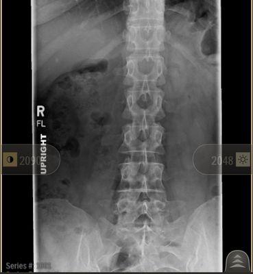 We examine for scoliosis. Curvature of the spine.