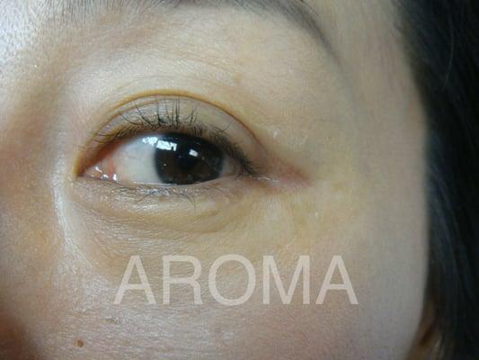 BEFORE EYE-LINE PERMANENT MAKEUP