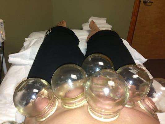 Cupping on my stomach