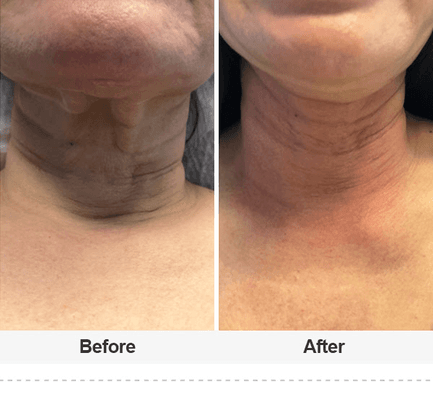 Great improvement to loose skin in the neck area with the Wake Up Beautiful Thread Lift. Non surgical and no down time.