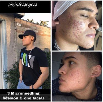 Microneedling 200$