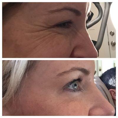 Before/after Botox for crows feet while smiling