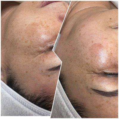 Dermaplaning Before + After