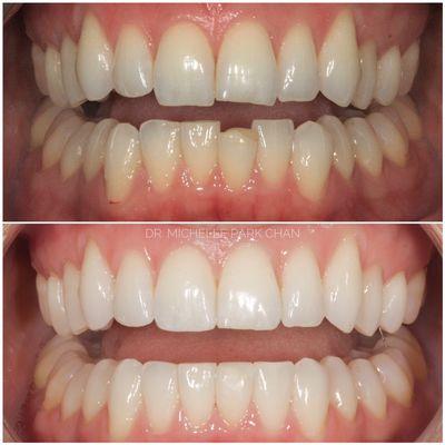 Invisalign and bonding