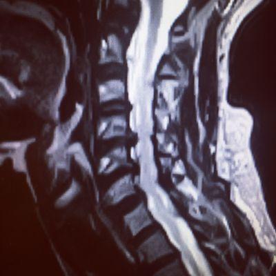 An MRI of the neck: cervical spine. A lot of problems. Obvious disc herniation.