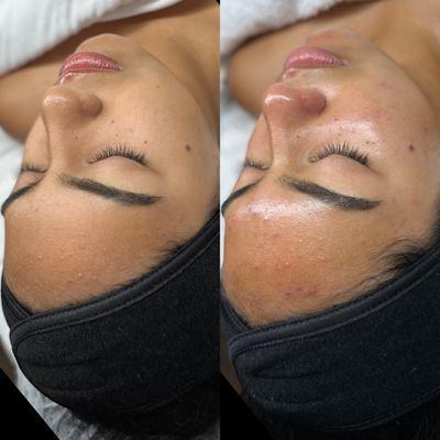 Customized HydraFacial Acne treatment