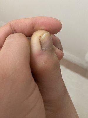 Cut my my skin and caught the corner of my nail