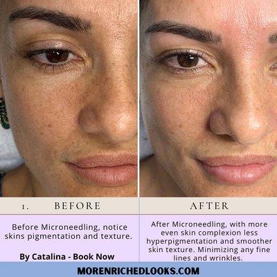 Microneedling Facials