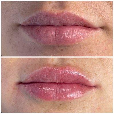 Service : Luscious Lips with Filler