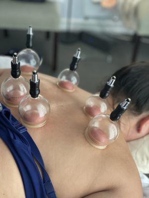 Cupping for tight muscles