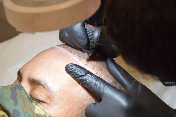 On Going Scalp Micropigmentation Procedure