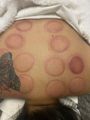 Cupping