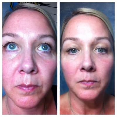 Rejuvenate your skin! See results !!