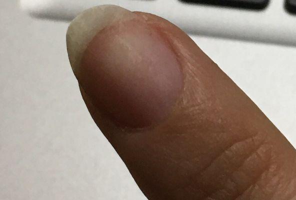 Unevenly filed and greatly damaged nails