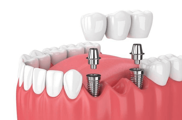 Implantation Dentistry