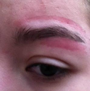 FIRST DEGREE BURN due to an eyebrow waxing done at PLANET NAIL AND SPA