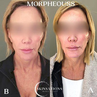 Morpheous8 Transformation! This client saw great improvement in her neck, cheeks, & jawline.