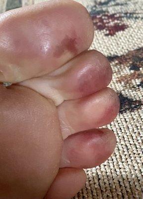 Raw toes from callus remover!!