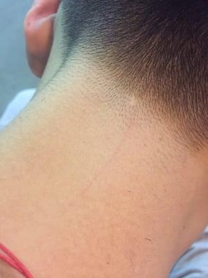 The barber cut wound on my boyfriend's neck! This pic is 5 hours after they hurt my boyfriend!