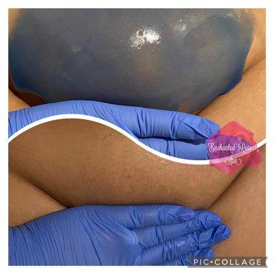 Vajacial/Brazilian using sugaring hair removal technique. This service includes a hydrojelly mask. (Pictured-spot diminishing ALA mask)