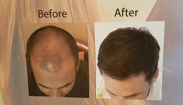 Hair loss men and women