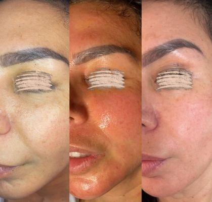 Radiance Renew Medical Facial Treatment. 
After just 2 sessions. Skin look totally revived and refreshed.